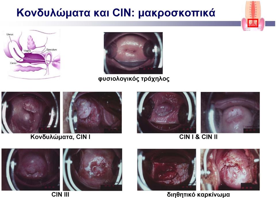 τράχηλος Κονδυλώματα, CIN I