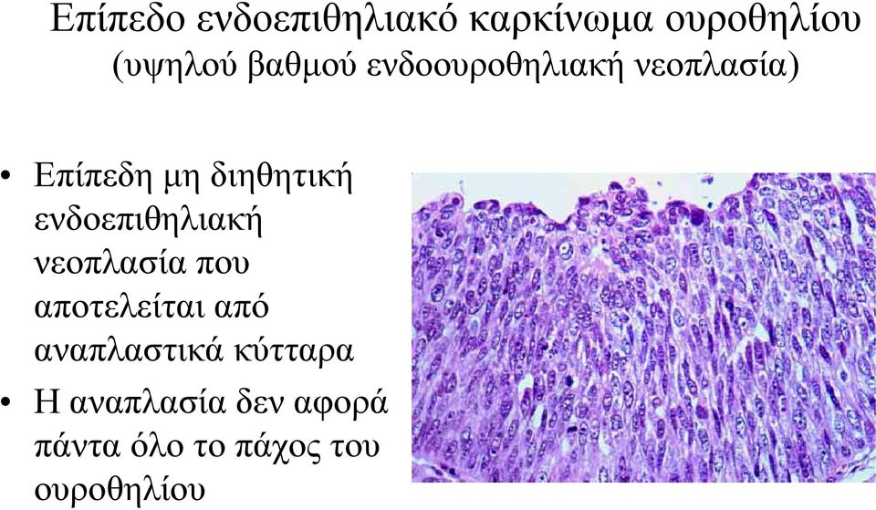 ενδοεπιθηλιακή νεοπλασία που αποτελείται από αναπλαστικά