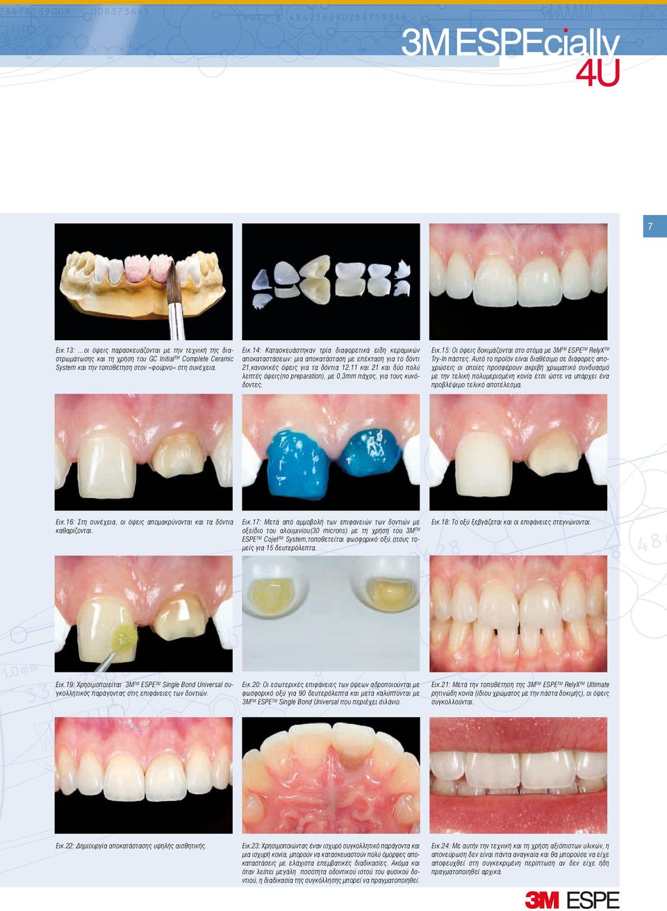 14: Κατασκευάστηκαν τρία διαφορετικά είδη κεραμικών αποκαταστάσεων: μια αποκατάσταση με επέκταση για το δόντι 21,κανονικές όψεις για τα δόντια 12,11 και 21 και δύο πολύ λεπτές όψεις(no preparation),