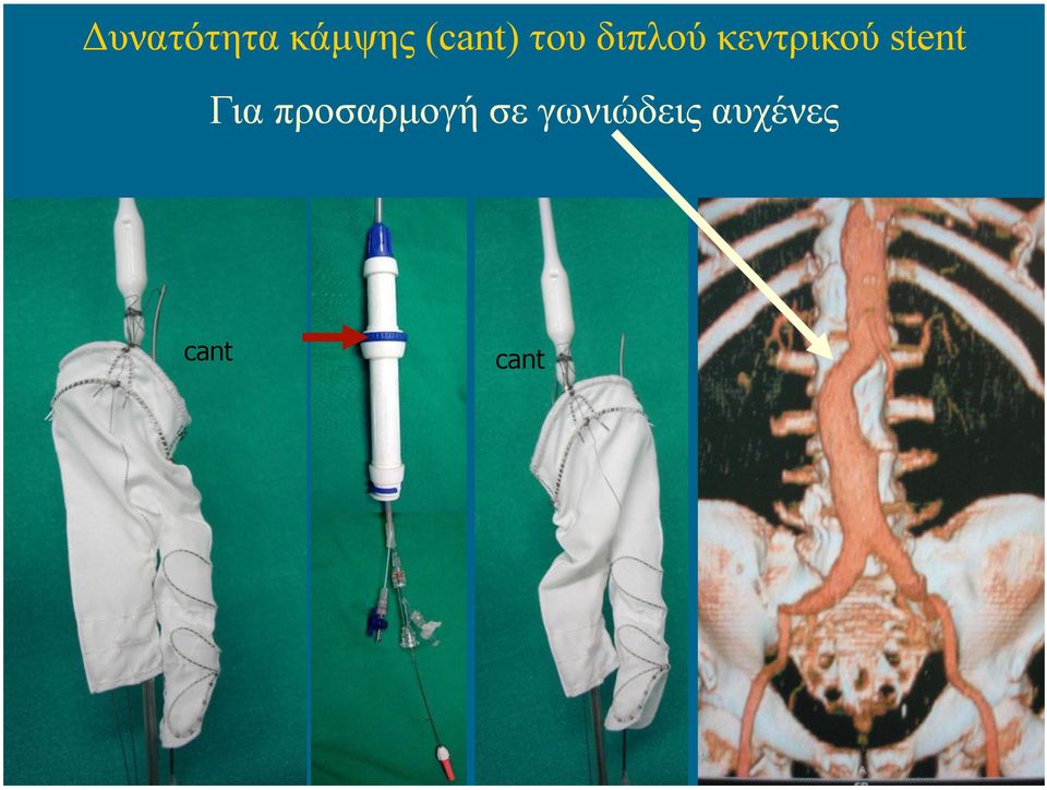 stent Για προσαρµογή σε