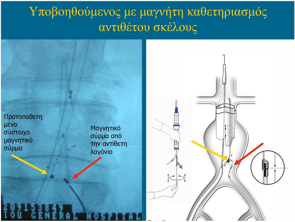 Προτοποθετη µένο σύστοιχο