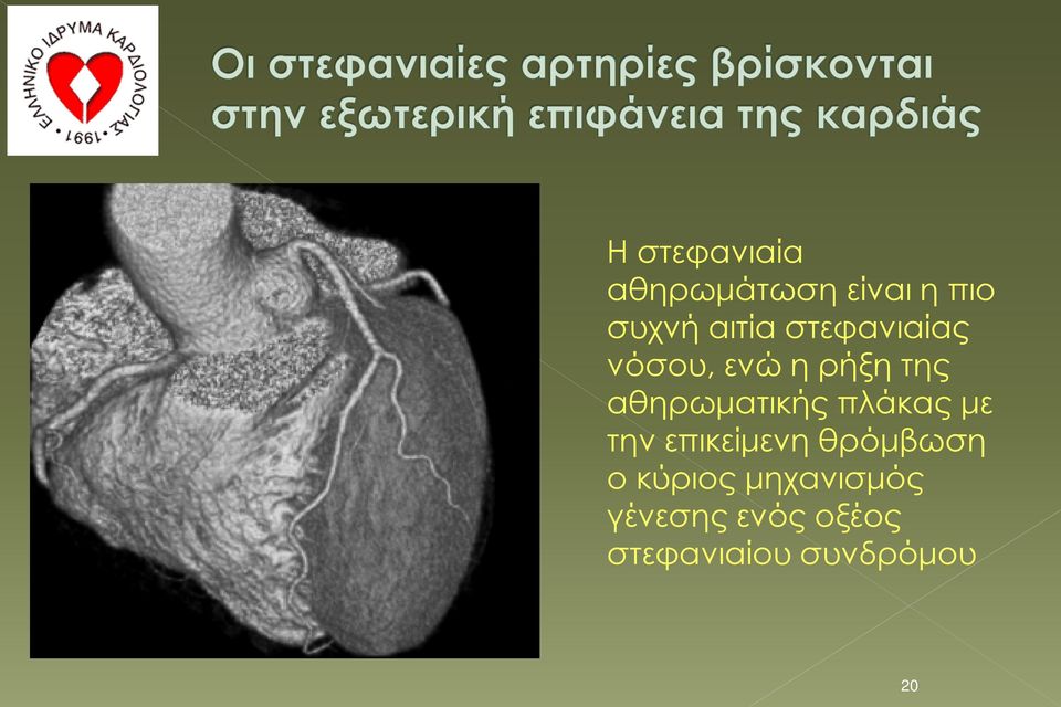 πλάκας με την επικείμενη θρόμβωση ο κύριος
