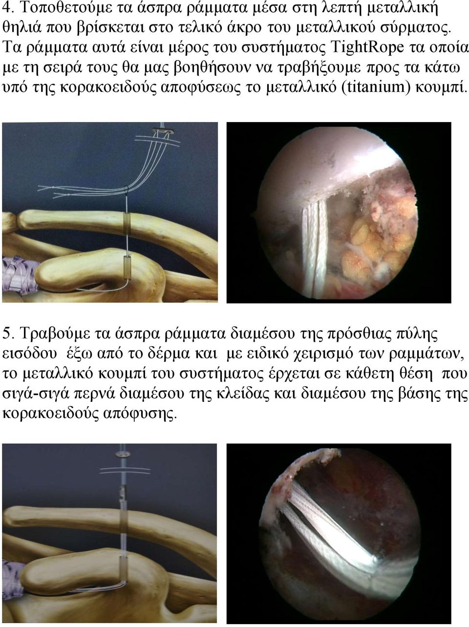 κορακοειδούς αποφύσεως το μεταλλικό (titanium) κουμπί. 5.