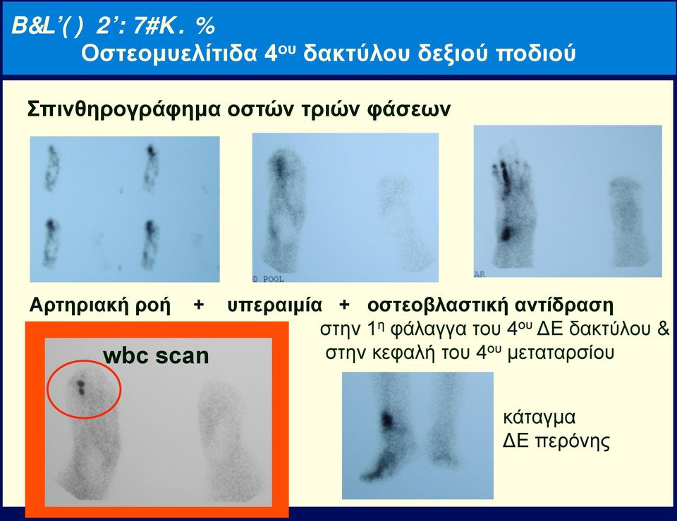 υπεραιµία + οστεοβλαστική αντίδραση στην 1η φάλαγγα του 4ου