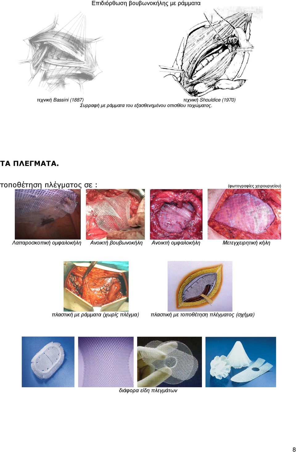 τοποθέτηση πλέγµατος σε : Λαπαροσκοπική οµφαλοκήλη (φωτογραφίες χειρουργείου) Ανοικτή βουβωνοκήλη