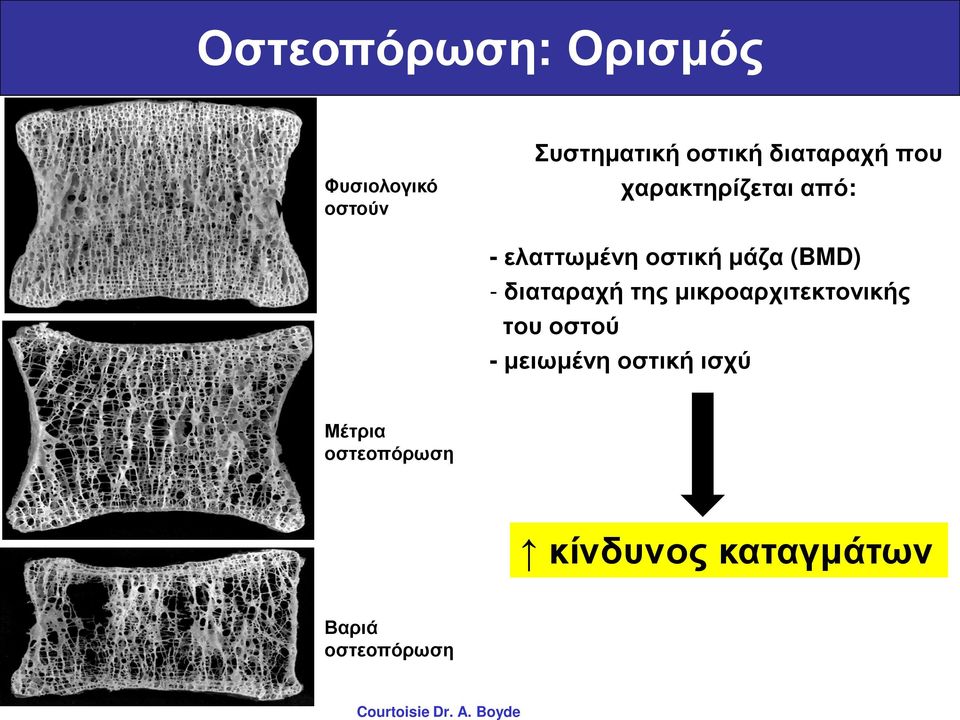 διαταραχή που χαρακτηρίζεται από: - ελαττωμένη οστική μάζα (BMD) -