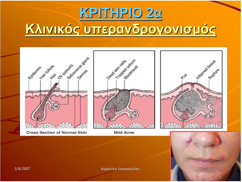 υπερανδρογονισµός