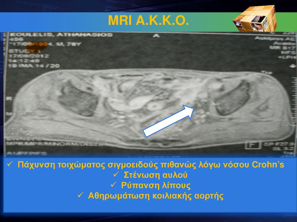 πιθανώς λόγω νόσου Crohn s