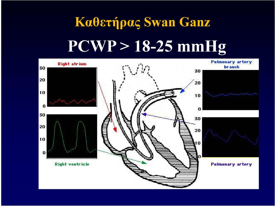 PCWP >