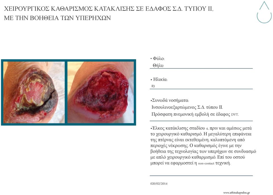 Η μεγαλύτερη επιφάνεια της πτέρνας είναι εκτεθειμένη, καλυπτόμενη από περιοχές νέκρωσης.