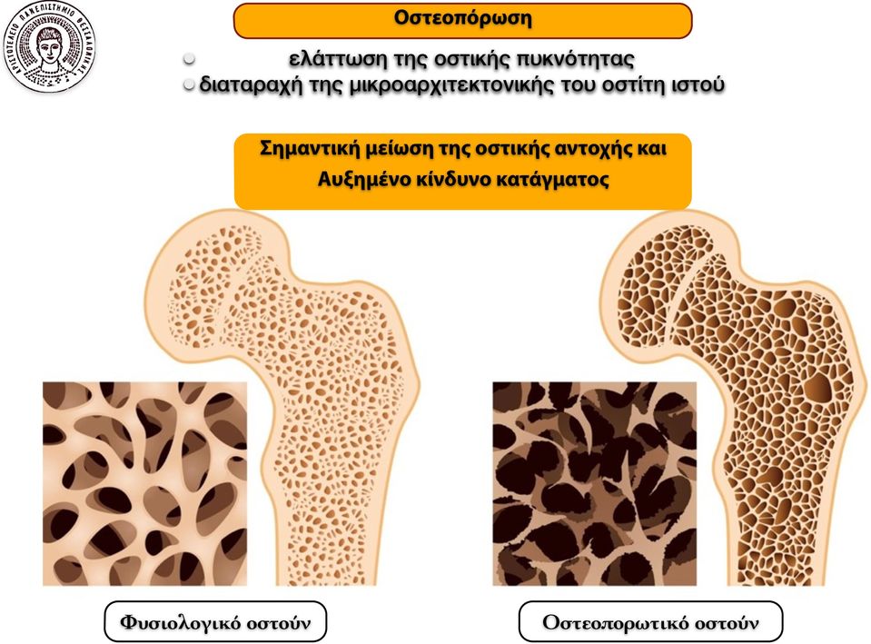 Σημαντική μείωση της οστικής αντοχής και Αυξημένο