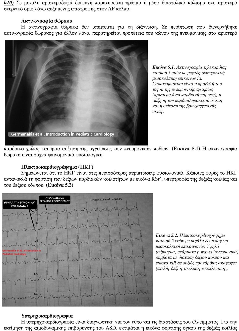 Σε περίπτωση που διενεργήθηκε ακτινογραφία θώρακος για άλλον λόγο, παρατηρείται προπέτεια του κώνου της πνευµονικής στο αριστερό Εικόνα 5.1.