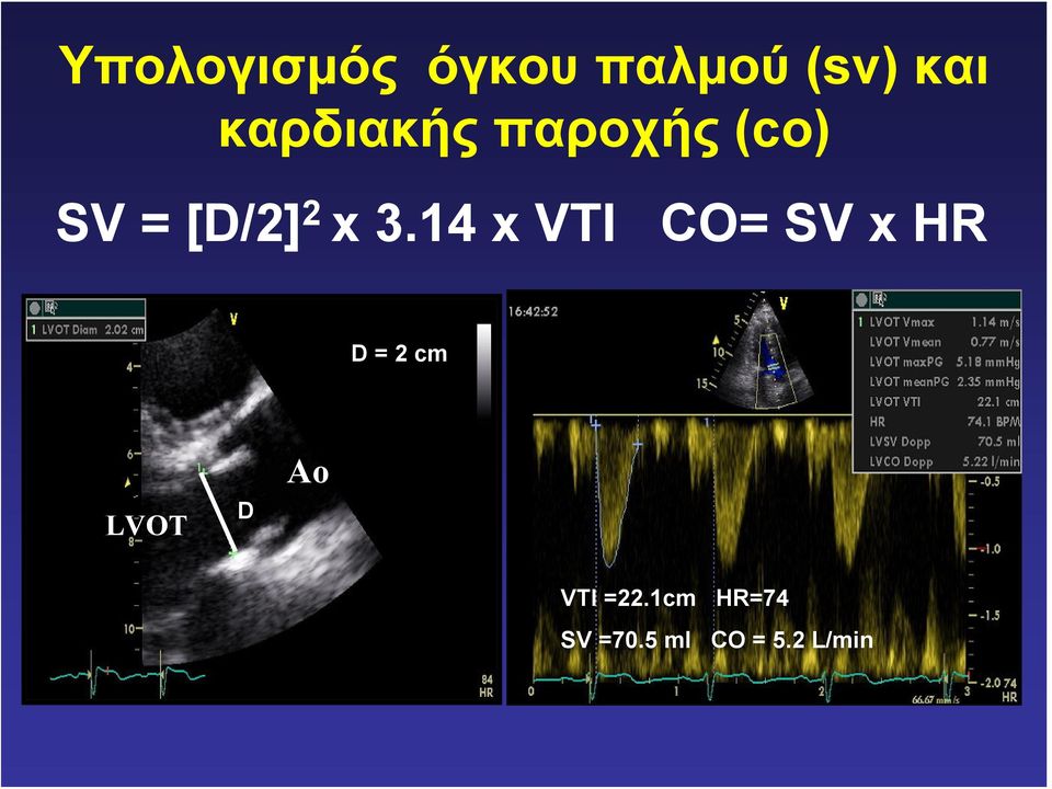 14 x VTI CO= SV x HR D = 2 cm LVOT D Αο