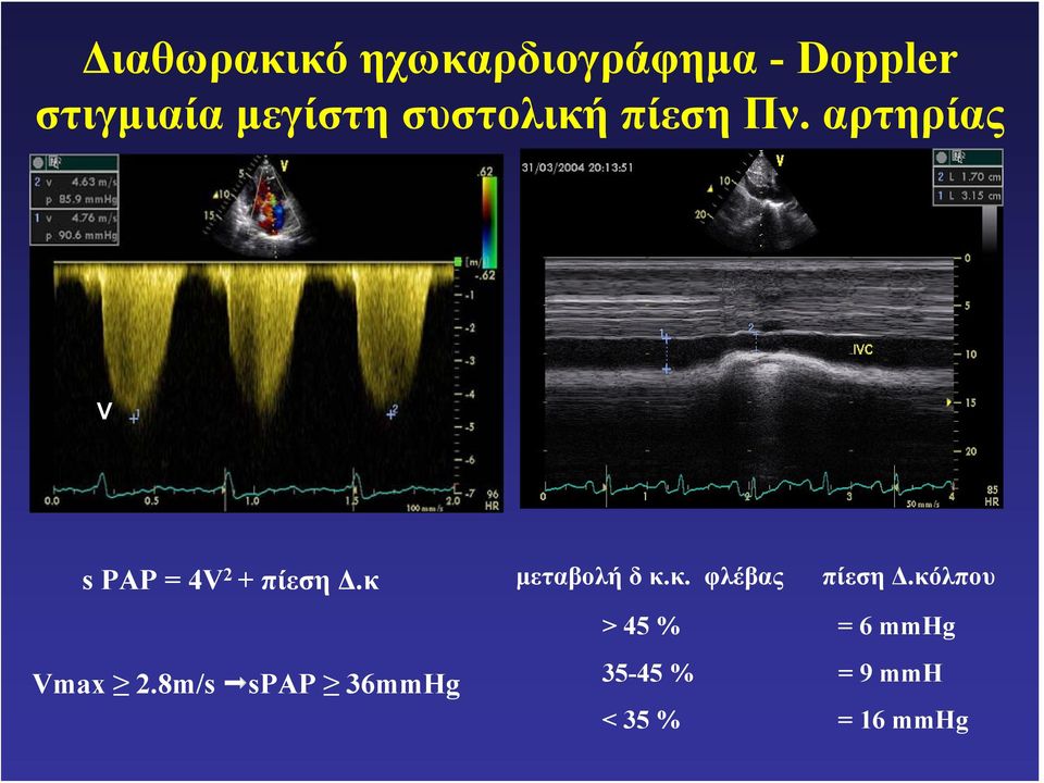 αρτηρίας V spap = 4V 2 + πίεση Δ.κ Vmax 2.