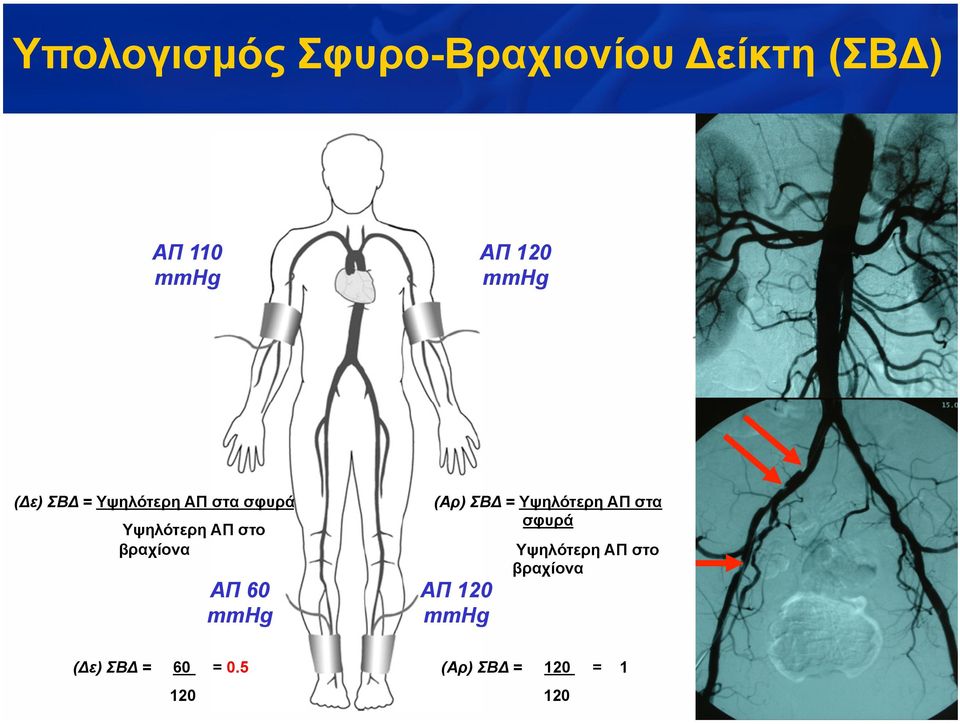 βραχίονα ΑΠ 60 mmhg (Αρ) ΣΒΔ = Υψηλότερη ΑΠ στα σφυρά ΑΠ 120