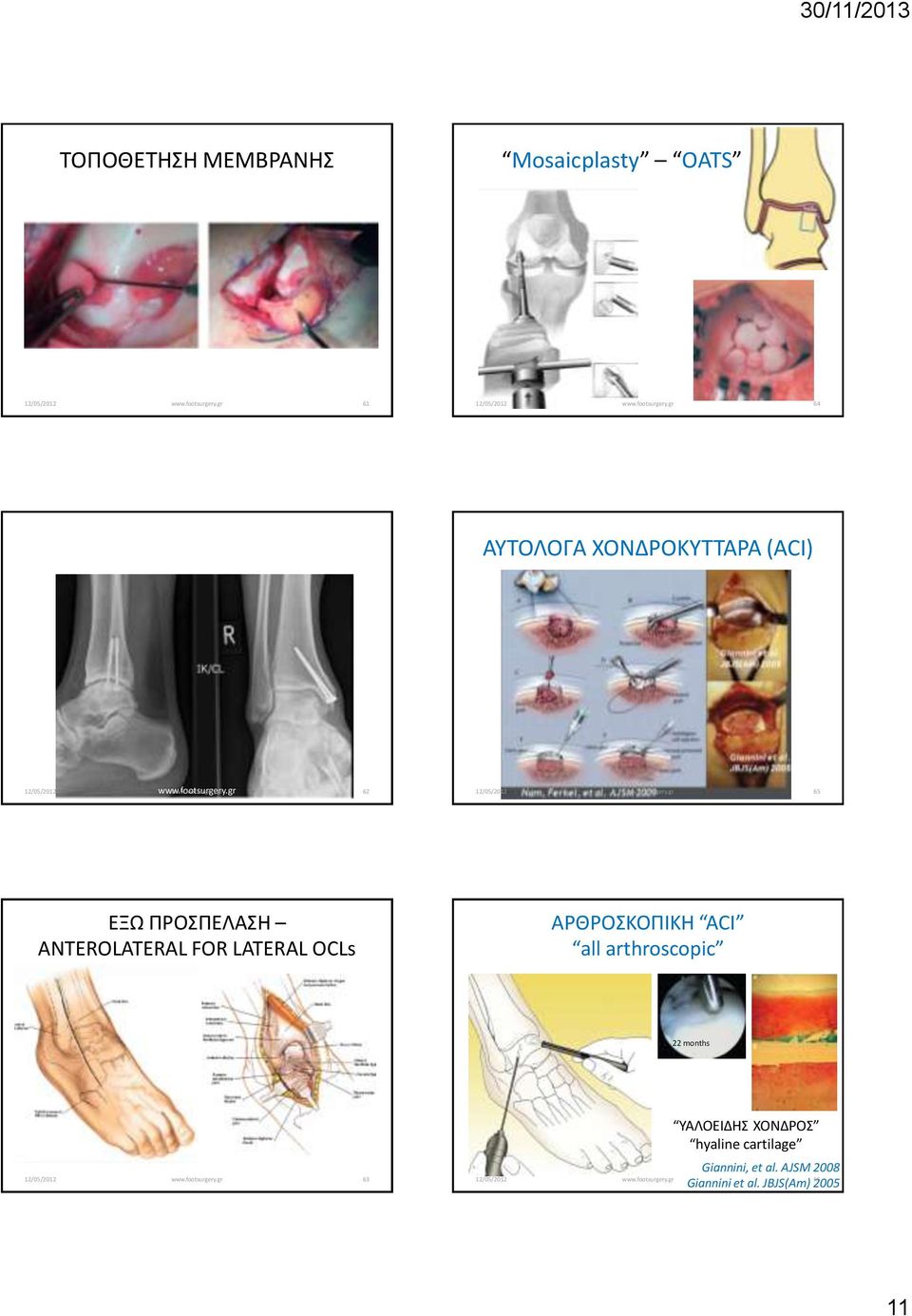 ΑΡΘΡΟΣΚΟΠΙΚΗ ACI all arthroscopic 22 months 63 ΥΑΛΟΕΙΔΗΣ ΧΟΝΔΡΟΣ