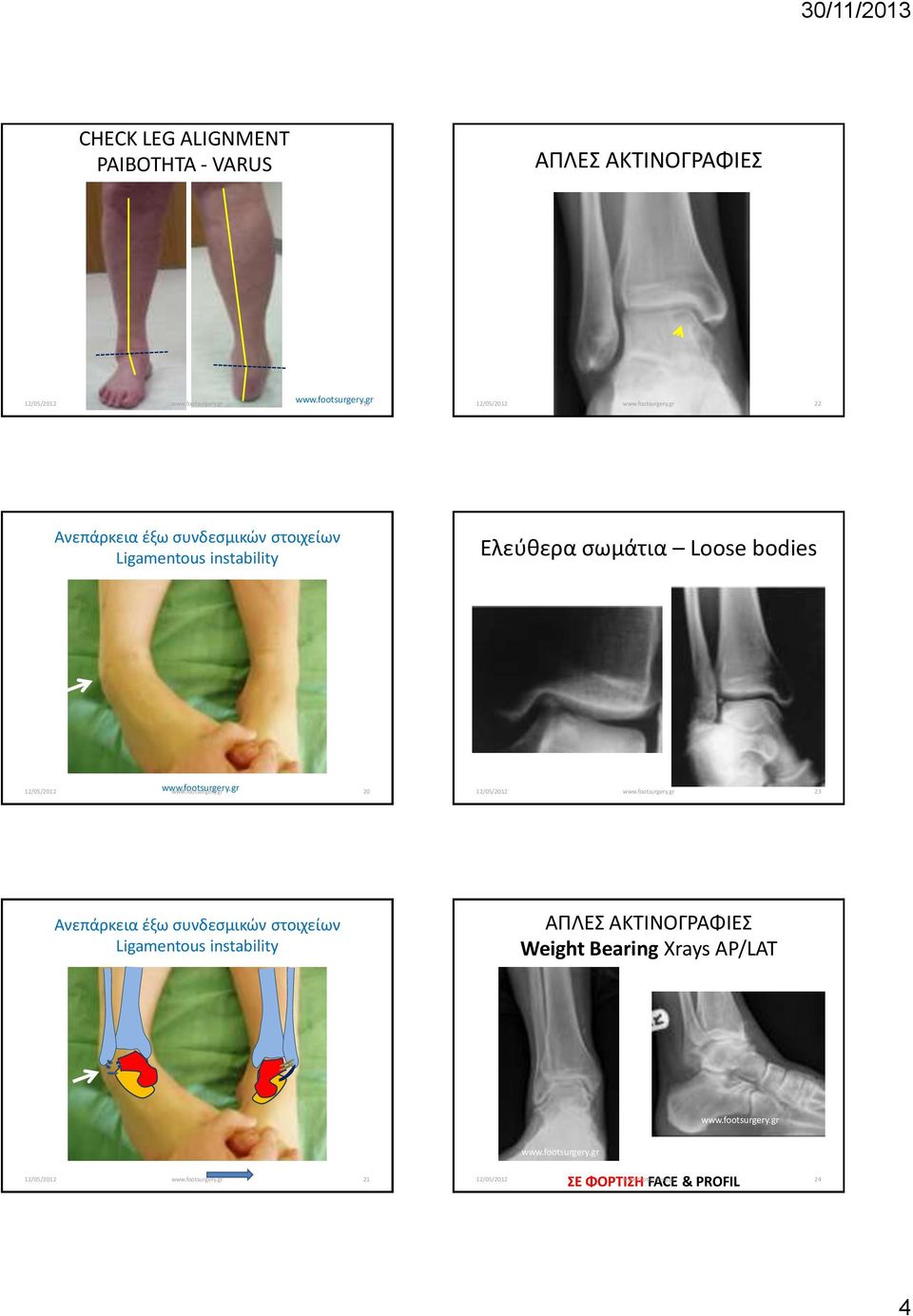 23 Ανεπάρκεια έξω συνδεσμικών στοιχείων Ligamentous instability ΑΠΛΕΣ