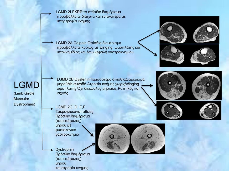 Muscular Dystrophies) LGMD 2B DysferlinΠερισσότερο οπίσθιοδιαμέρισμα μηρούμε συνοδό Ατροφία κνήμης χωρίςwinging ωμοπλάτης Όχι δικέφαλος