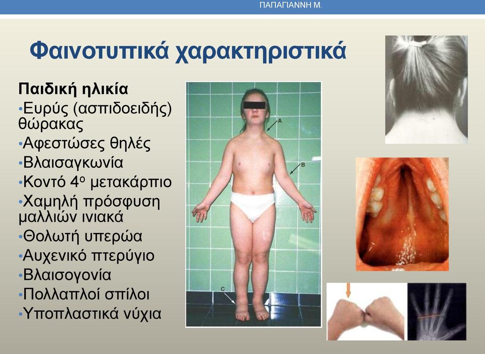(ασπιδοειδής) θώρακας Αφεστώσες θηλές Βλαισαγκωνία Κοντό 4 ο