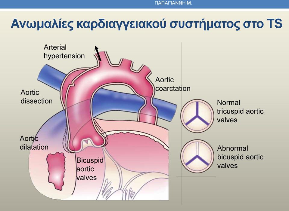 Aortic dissection Aortic coarctation Normal tricuspid