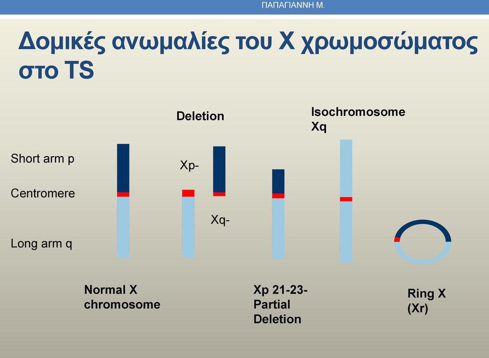 Deletion Isochromosome Xq Short arm p Xp-