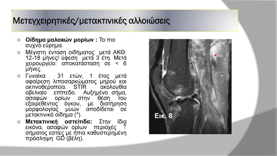 Γυναίκα 31 ετών, 1 έτος μετά αφαίρεση λιποσαρκώματος μηρού και ακτινοθεραπεία. STIR ακολουθία οβελιαίο επίπεδο.