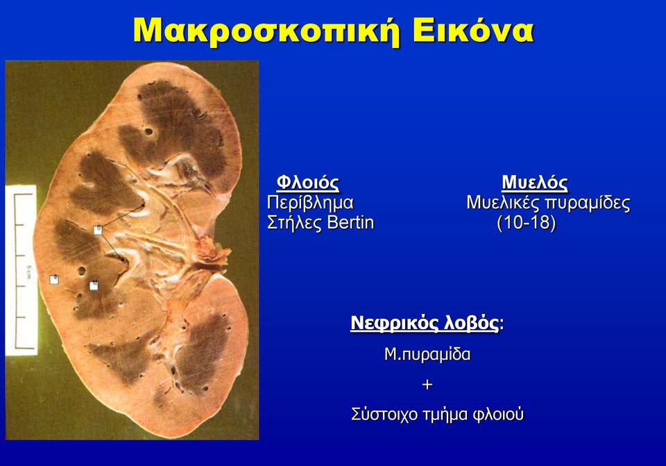 Στήλες Bertin (10-18) Νεφρικός