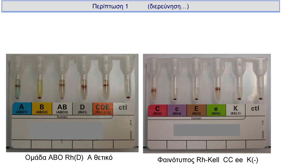 ΑΒΟ Rh(D) A θετικό