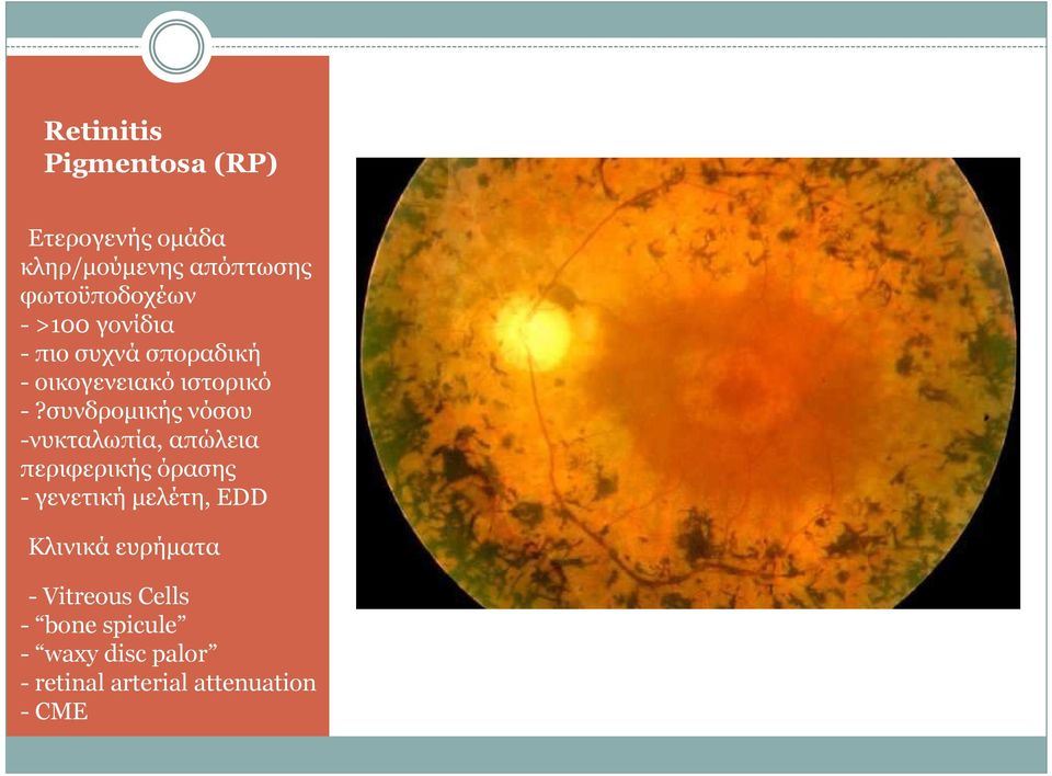 συνδροµικής νόσου -νυκταλωπία, απώλεια περιφερικής όρασης - γενετική µελέτη, EDD