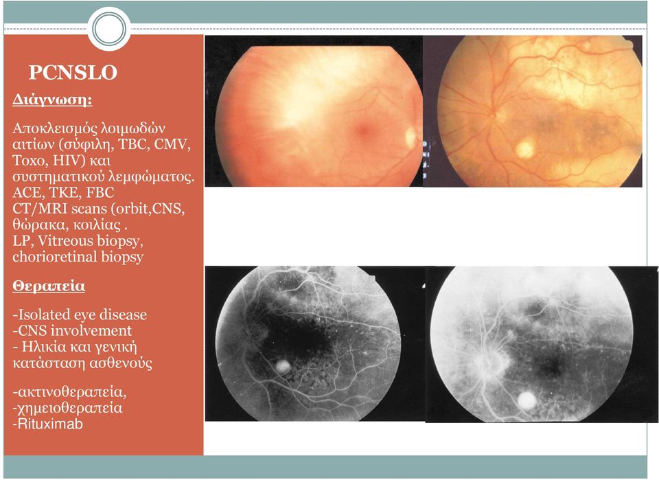 LP, Vitreous biopsy, chorioretinal biopsy Θεραπεία -Isolated eye disease -CNS