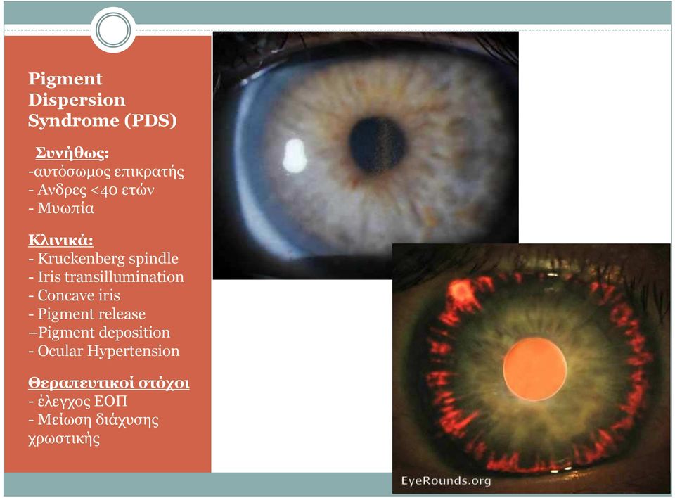 transillumination - Concave iris - Pigment release Pigment deposition