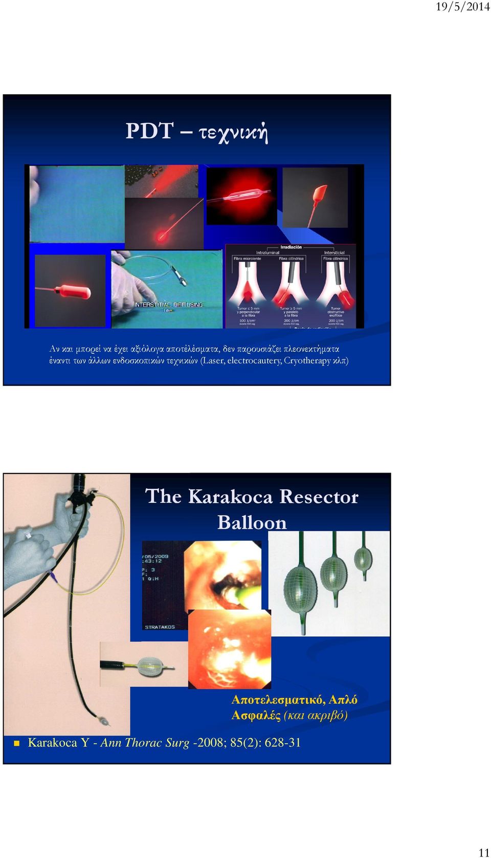 electrocautery, Cryotherapy κλπ) The Karakoca Resector Balloon
