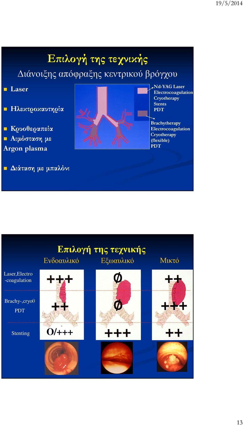 Brachytherapy Electrocoagulation Cryotherapy (flexible) PDT ιάταση µε µ αλόνι