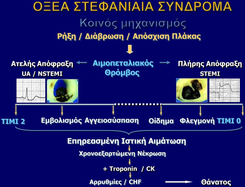 Αγγειοσύσπαση Οίδημα Φλεγμονή TIMI 0 Επηρεασμένη Ιστική