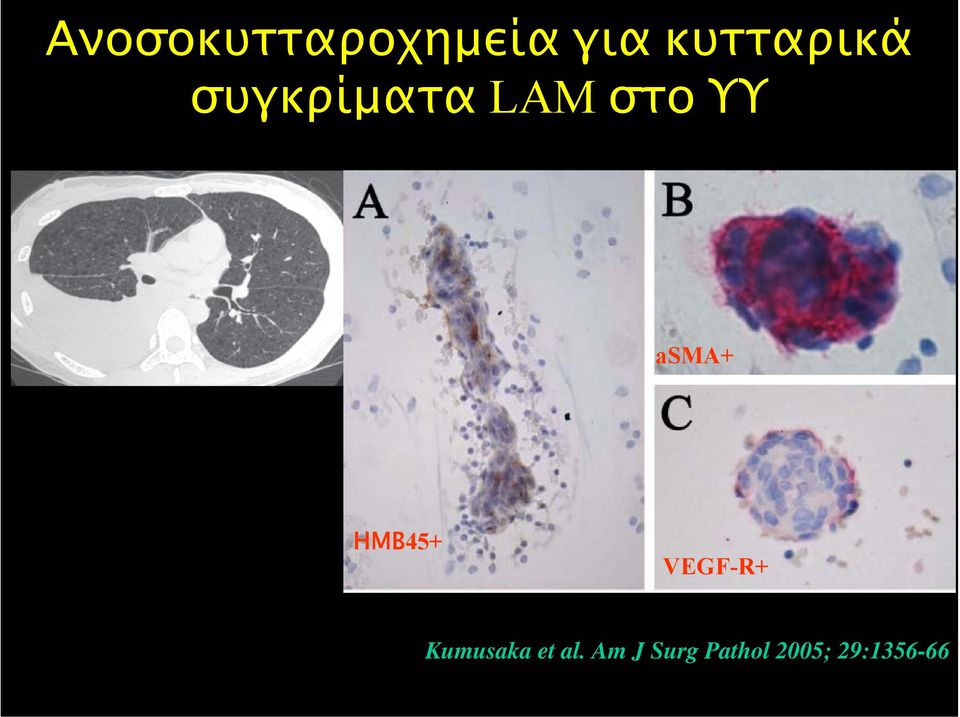 asma+ ΗΜΒ45+ VEGF-R+ Kumusaka