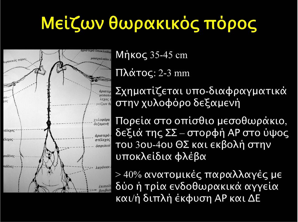 δεξιά της ΣΣ στορφή ΑΡ στο ύψος του 3ου-4ου ΘΣ και εκβολή στην υποκλείδια