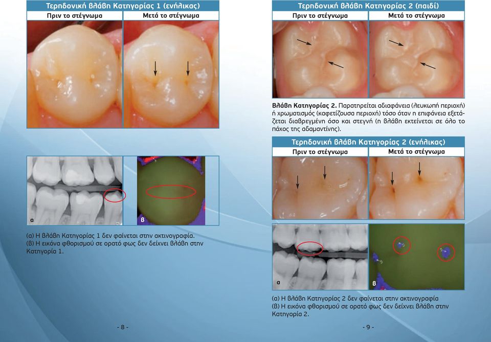 εκτείνεται σε όλο το πάχος της αδαμαντίνης). Τερηδονική βλάβη Κατηγορίας 2 (ενήλικας) α β (α) Η βλάβη Κατηγορίας 1 δεν φαίνεται στην ακτινογραφία.