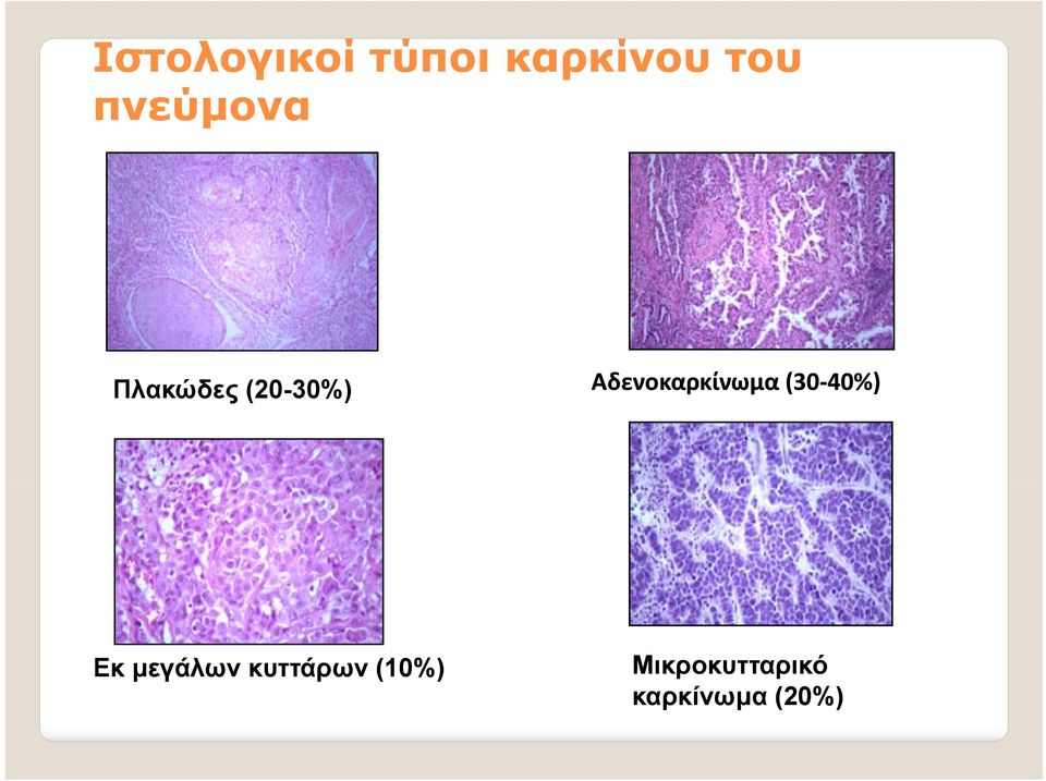 Αδενοκαρκίνωμα (30 40%) Εκ μεγάλων
