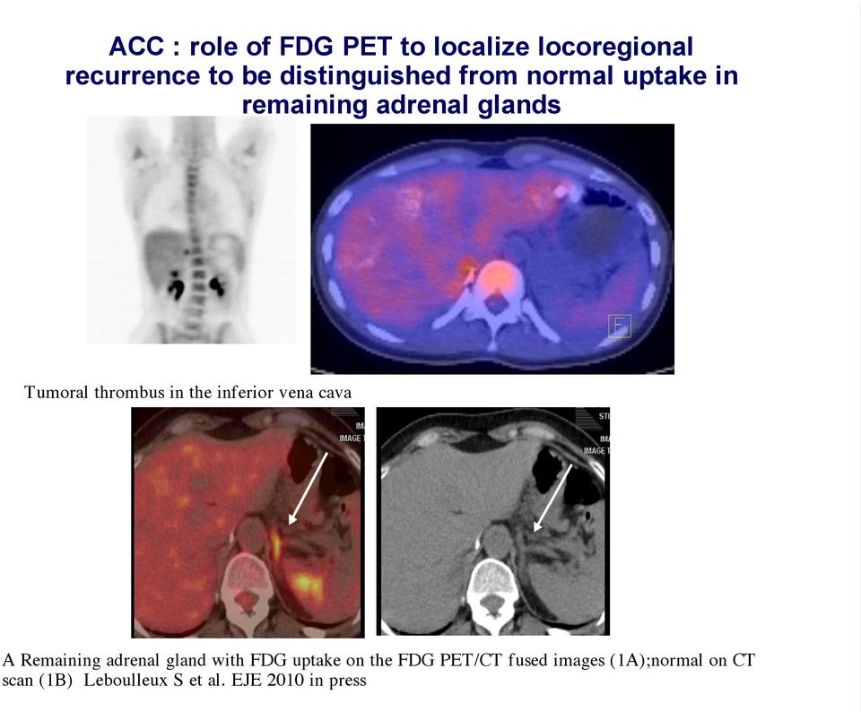 thrombus in the inferior vena cava A Remaining adrenal gland with FDG uptake
