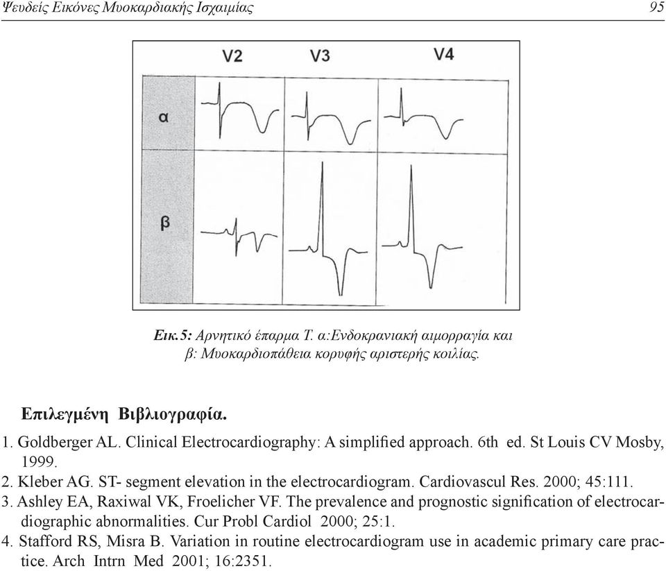 ST- segment elevation in the electrocardiogram. Cardiovascul Res. 2000; 45:111. 3. Ashley EA, Raxiwal VK, Froelicher VF.