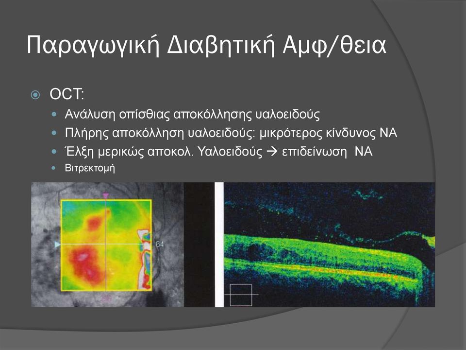 αποκόλληση υαλοειδούς: μικρότερος κίνδυνος ΝΑ
