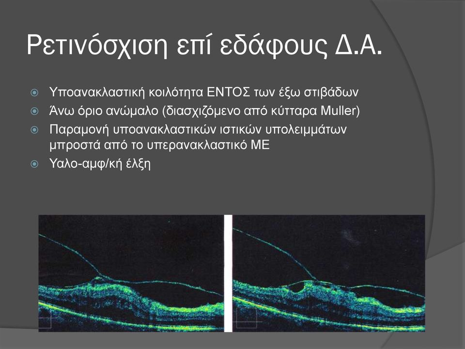 όριο ανώμαλο (διασχιζόμενο από κύτταρα Muller) Παραμονή