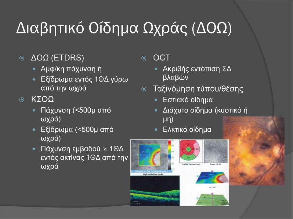 Εστιακό οίδημα Πάχυνση (<500μ από ωχρά) Διάχυτο οίδημα (κυστικό ή μη) Εξίδρωμα