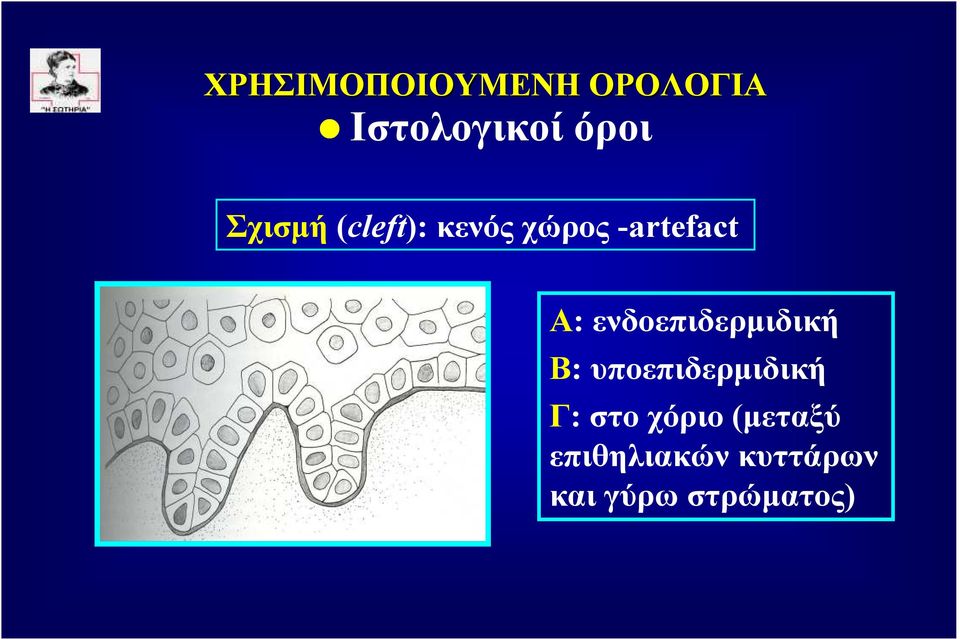 υποεπιδερµιδική Γ: στο χόριο