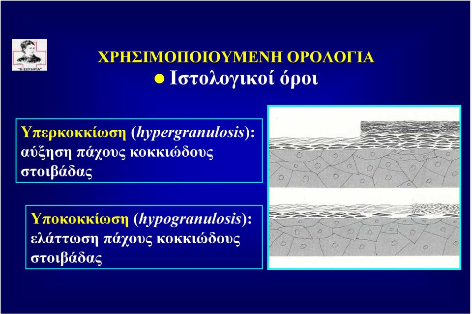 στοιβάδας Υποκοκκίωση