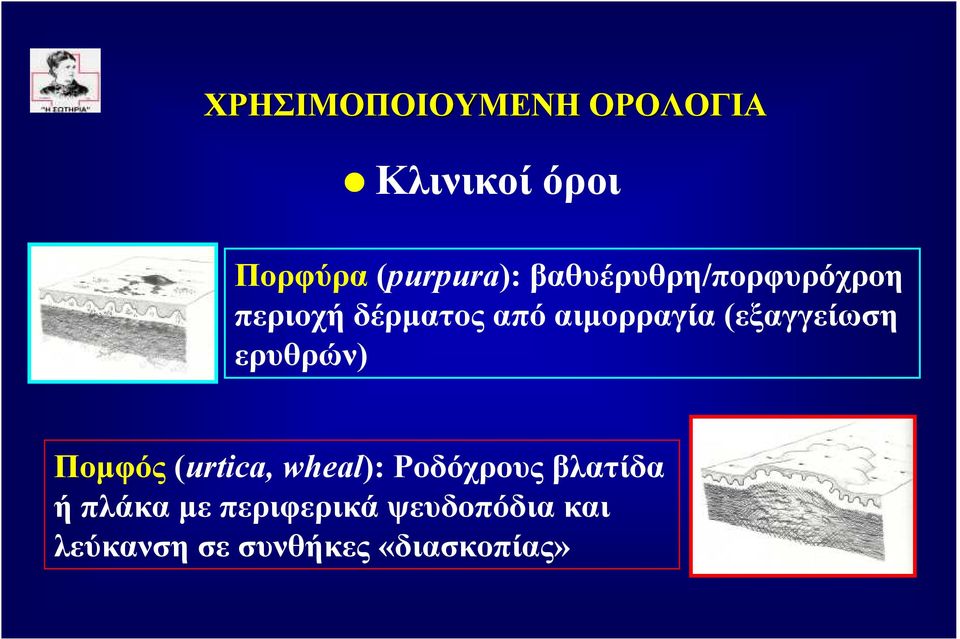 Ποµφός (urtica, wheal): Ροδόχρους βλατίδα ή πλάκα µε