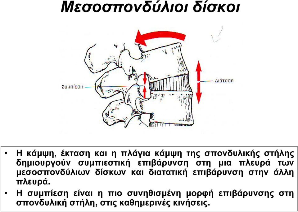 μεσοσπονδύλιων δίσκων και διατατική επιβάρυνση στην άλλη πλευρά.