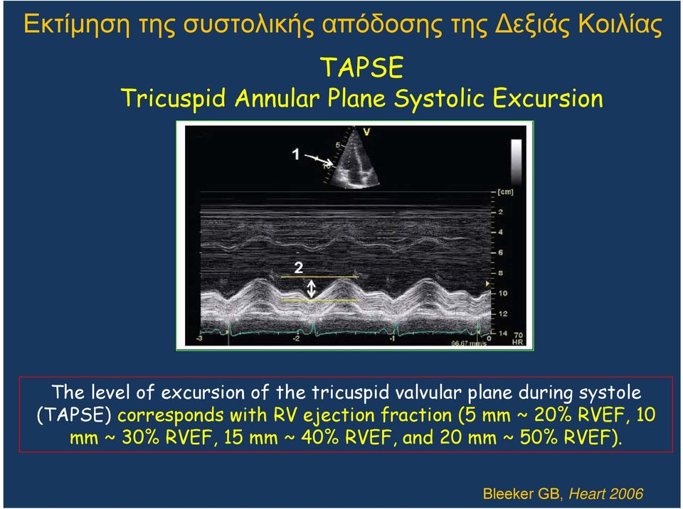 plane during systole (TAPSE) corresponds with RV ejection fraction (5 mm ~ 20%