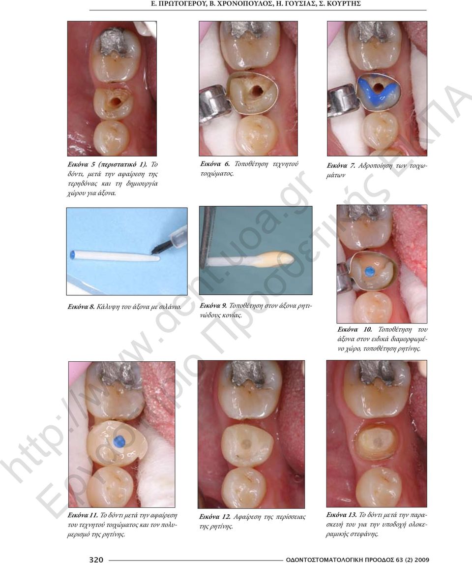Το δόντι μετά την αφαίρεση του τεχνητού τοιχώματος και τον πολυμερισμό της ρητίνης. Εικόνα 12. Αφαίρεση της περίσσειας της ρητίνης. Εικόνα 7.