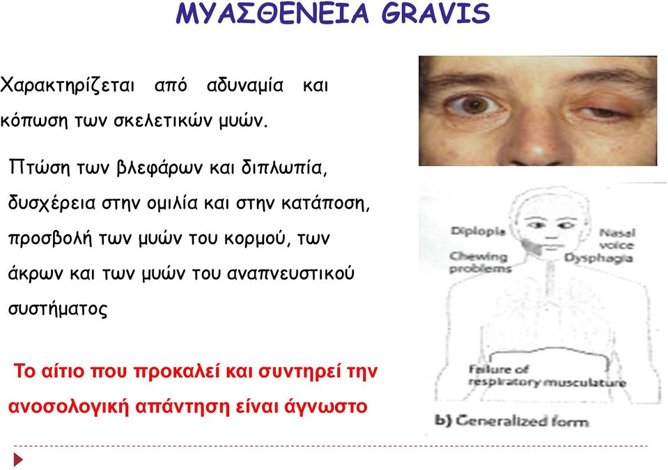 προσβολή των μυών του κορμού, των άκρων και των μυών του αναπνευστικού